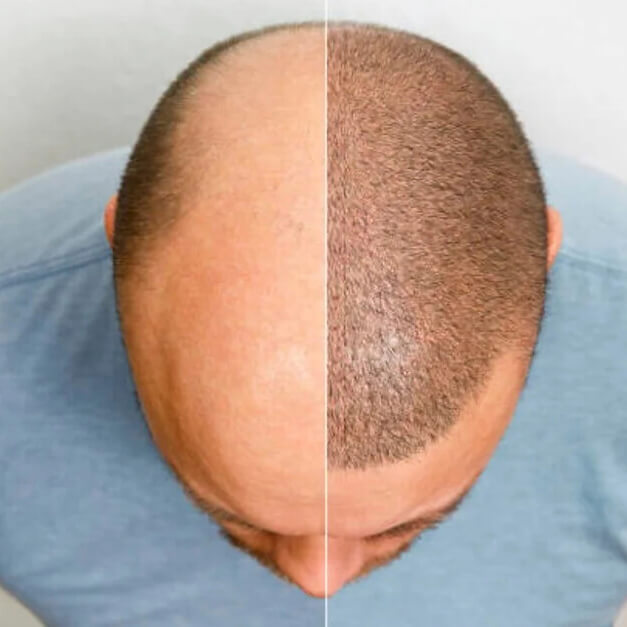 Hair transplantation
